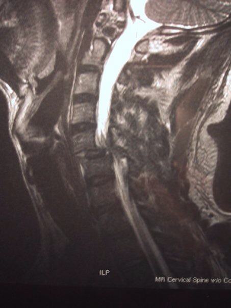 Spinal Cord Injury Scan