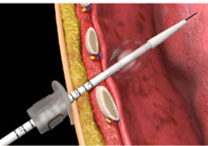 chest tube insertion into body example